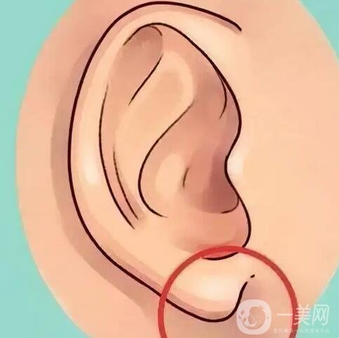 玻尿酸注射豐耳垂要注意什么？術(shù)后護理詳細(xì)介紹