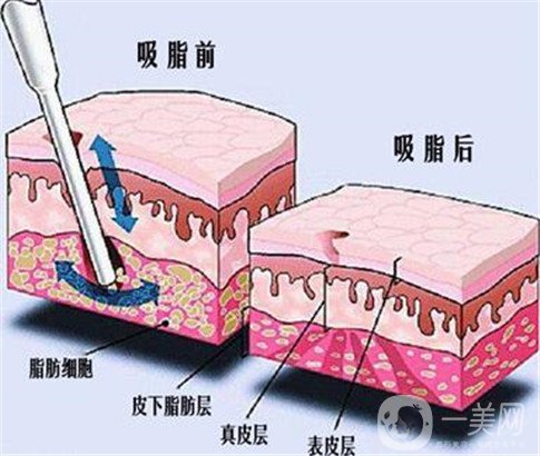 360環(huán)形抽脂手術大概要多少錢？