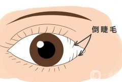 倒睫可能引起哪些癥狀？有哪些矯正倒睫的方法？