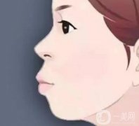 正頜手術有哪些副作用？哪些人適合做？