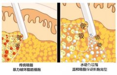 水動力吸脂、雷射溶脂、隆胸，三下合一雕塑性感曲線