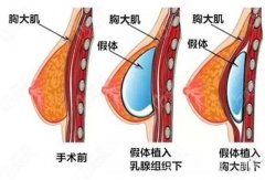 水動力隆胸達8成?