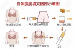 深V不再只是夢(mèng)想，自體脂肪豐胸?zé)衢T問(wèn)題及解答介紹