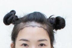 女性植發(fā)前需要注意什么?