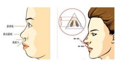 不同價(jià)格的綜合隆鼻差在哪?綜合隆鼻后為何會(huì)成朝天鼻?