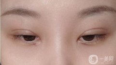 內(nèi)眼角太大怎么辦?修復(fù)內(nèi)眼角后眼睛會(huì)變小嗎?