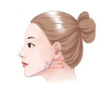 你對(duì)下頜角手術(shù)了解多少?有必要做下頜角手術(shù)嗎?