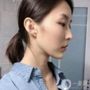 我之前其實(shí)也有去做過豐下巴，我之前是玻尿酸注射，一開始的效果還算是可以