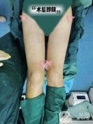 自從在醫(yī)院做了大腿吸脂手術(shù)以后，我終于擁有了兩條纖細(xì)筆直的漫畫腿