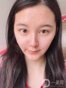 在整個過程中不會感覺到什么疼痛，現(xiàn)在熱瑪吉已經(jīng)發(fā)展到第五代了