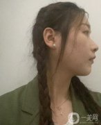 剛做完拉皮的這幾天真的是特別的不適應，因為每天都有在戴頭套