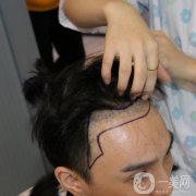 在朋友推薦之下，我終究還是做了植發(fā)手術(shù)，經(jīng)過長期以來的生長