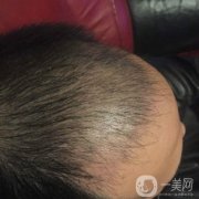 而我也是在這個時候出現(xiàn)的嚴(yán)重脫發(fā)，而且我覺得自己的情況要比當(dāng)初的爸爸更