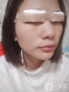 心心念念的雙眼皮終于是做完了，對自己的雙眼皮一直以來都是特別的不滿意