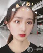 眼綜合手術(shù)已經(jīng)過去四個月的時間了，自從我做完手術(shù)之后，我?guī)ьI(lǐng)了我身邊的