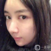 做完面部填充手術(shù)已經(jīng)半年的時(shí)間了，現(xiàn)在我的臉部脂肪已經(jīng)穩(wěn)定下來了