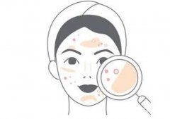 點(diǎn)陣激光有什么優(yōu)勢(shì)?，做點(diǎn)陣激光會(huì)痛嗎