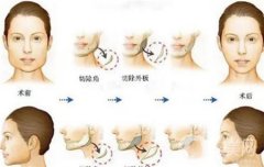 墊下巴用什么材料好，要多久才能完全恢復(fù)