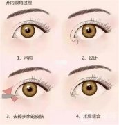 開眼角后會(huì)回縮嗎，要多久才能自然恢復(fù)