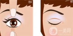 開眼角會(huì)留疤嗎?開眼角術(shù)后多久能恢復(fù)