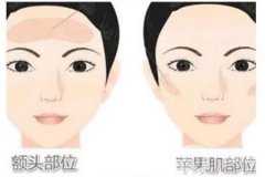 吸脂后會(huì)反彈嗎，吸脂術(shù)后需要注意什么