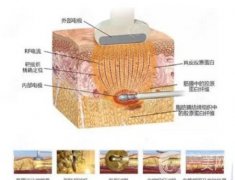 吸脂會(huì)不會(huì)反彈呢?吸脂有什么危害