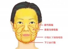 吸脂一次可以吸多少