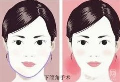 下頜角截骨術(shù)后多久能完全恢復(fù)