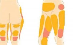 腿部吸脂有什么特點(diǎn)，正常走路有影響嗎