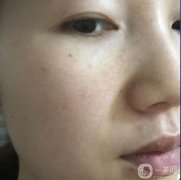 做完皮秒祛斑已經(jīng)是第15天了，做這個皮秒之前，會給你打麻藥，不用擔(dān)心疼
