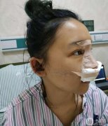 總覺得鼻子眼睛真的需要改良，鼻子不明顯，所以做了手術(shù)