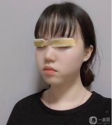 我是懶癌患者，據(jù)說貼雙眼皮貼不好，我的眼皮很容易松弛，權(quán)衡利弊，還是割