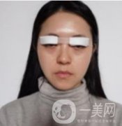 我來了，我來了，做的眼綜合，半個月才拆線 效果很好