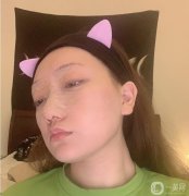 今天是術(shù)后第七天，縫線已經(jīng)拆線，醫(yī)生說恢復(fù)的不錯(cuò)