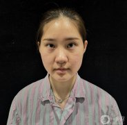 我的鼻子做了，前兩天沒敢洗臉