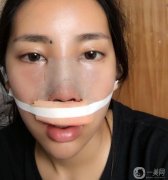 大概是隆鼻后第10天，去醫(yī)院把線取出來了