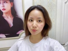 面部吸脂手術(shù)是一個純粹的微創(chuàng)手術(shù)所以在聽了醫(yī)生的建議后，我決定做面部吸