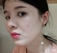 臉部的腫脹在慢慢減輕，淤青也在消失，越來越正常