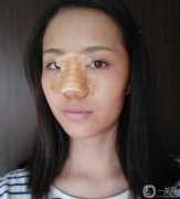 鼻子還在恢復(fù)中,還是有點硬，手感還沒有達(dá)到自然