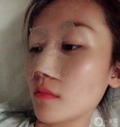 鼻部修復(fù)第7天醫(yī)生說我恢復(fù)的很好,越來越羨慕自己，不知道當(dāng)初的勇氣是從哪