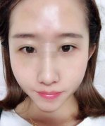 一直對自己的鼻子不滿意,雖然挺高，但是肉多