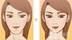 墊下巴的方法有哪些?各種墊下巴方法的優(yōu)點(diǎn)和缺點(diǎn)一覽!