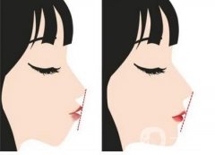 正頜手術(shù)可怕嗎?你知道正頜手術(shù)有多兇殘?