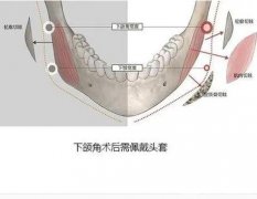 只做下頜角不做外板差別大不大?做不做主要取決于什么因素?
