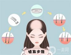 植發(fā)后，如何在家做好日常護(hù)理?需要用藥嗎?