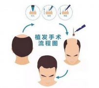 植發(fā)后還需要吃藥嗎?要吃多長時(shí)間?