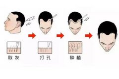 植發(fā)前的準(zhǔn)備工作和注意事項(xiàng)你都知道嗎?