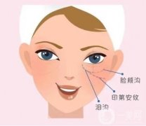 自體脂肪填充淚溝效果能維持多久?有哪些注意事項?效果如何?