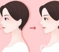 嘴凸會不會導(dǎo)致法令紋加重?矯正牙齒后會有改良嗎?
