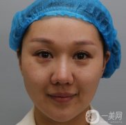 剛做完熱瑪吉的這幾天皮膚有一些緊致，臉看起來也是小了許多